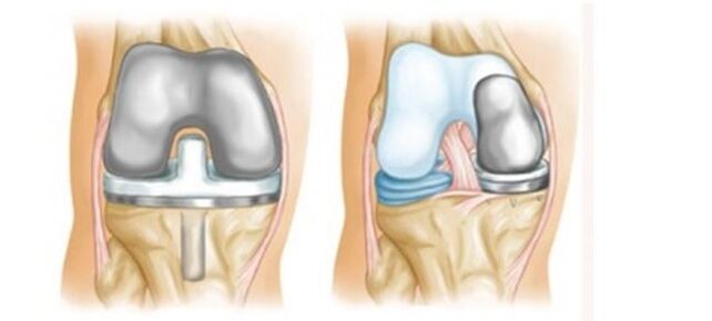 Endoprothèses pour l'arthrose de l'articulation du genou