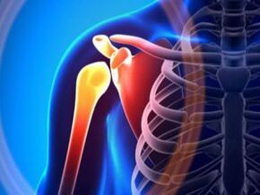 Articulation de l'épaule enflammée due à l'arthrose – une maladie chronique du système musculo-squelettique