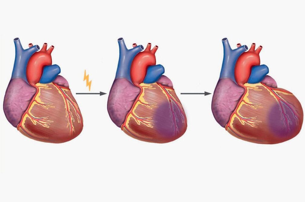 Une crise cardiaque provoque des douleurs dans les omoplates