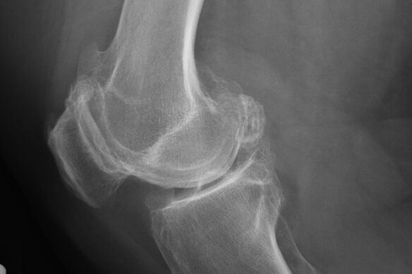 Méthodes pour diagnostiquer l'arthrose du genou