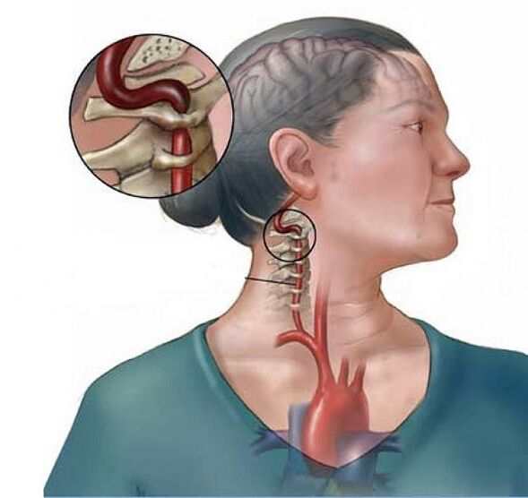 Syndrome de l'artère vertébrale avec ostéochondrose cervicale