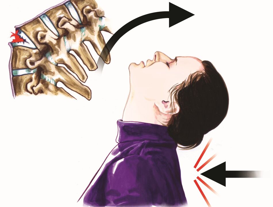 Les lésions de la colonne vertébrale comme cause de douleurs au cou