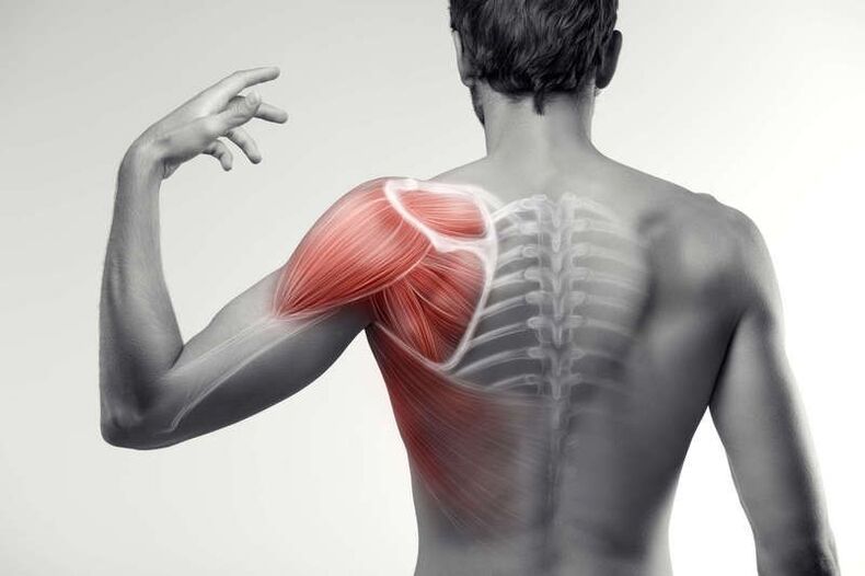 Zones de douleurs musculaires